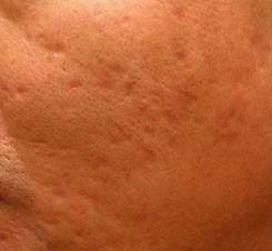 Scars Acne After Treatment
